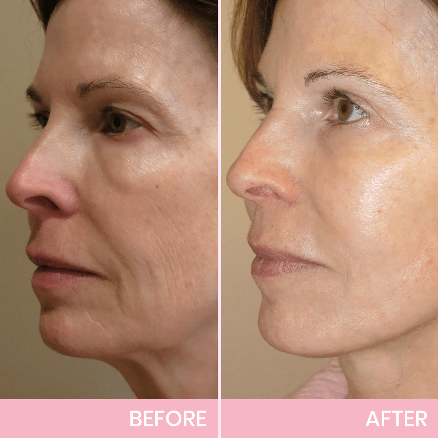 Fubsta™ V-Face Lifting Invisible Adhesive Tape 10 (For Continuous Use, Restores Firmness and Elasticity)