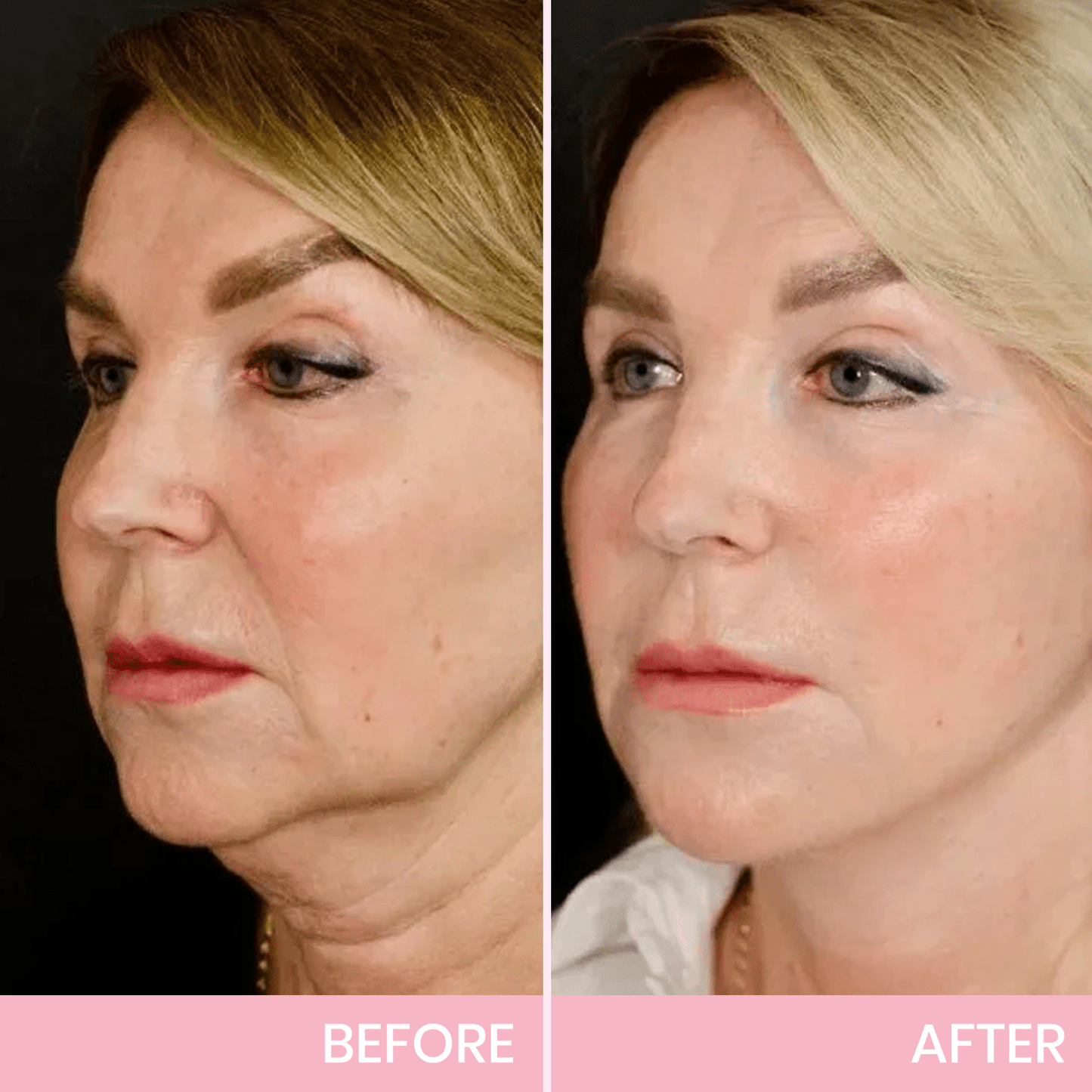Fubsta™ V-Face Lifting Invisible Adhesive Tape 10 (For Continuous Use, Restores Firmness and Elasticity)