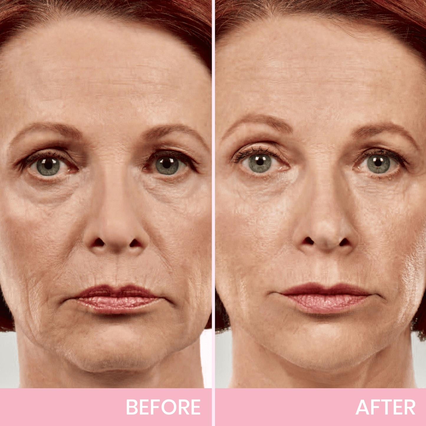 Fubsta™ V-Face Lifting Invisible Adhesive Tape 10 (For Continuous Use, Restores Firmness and Elasticity)